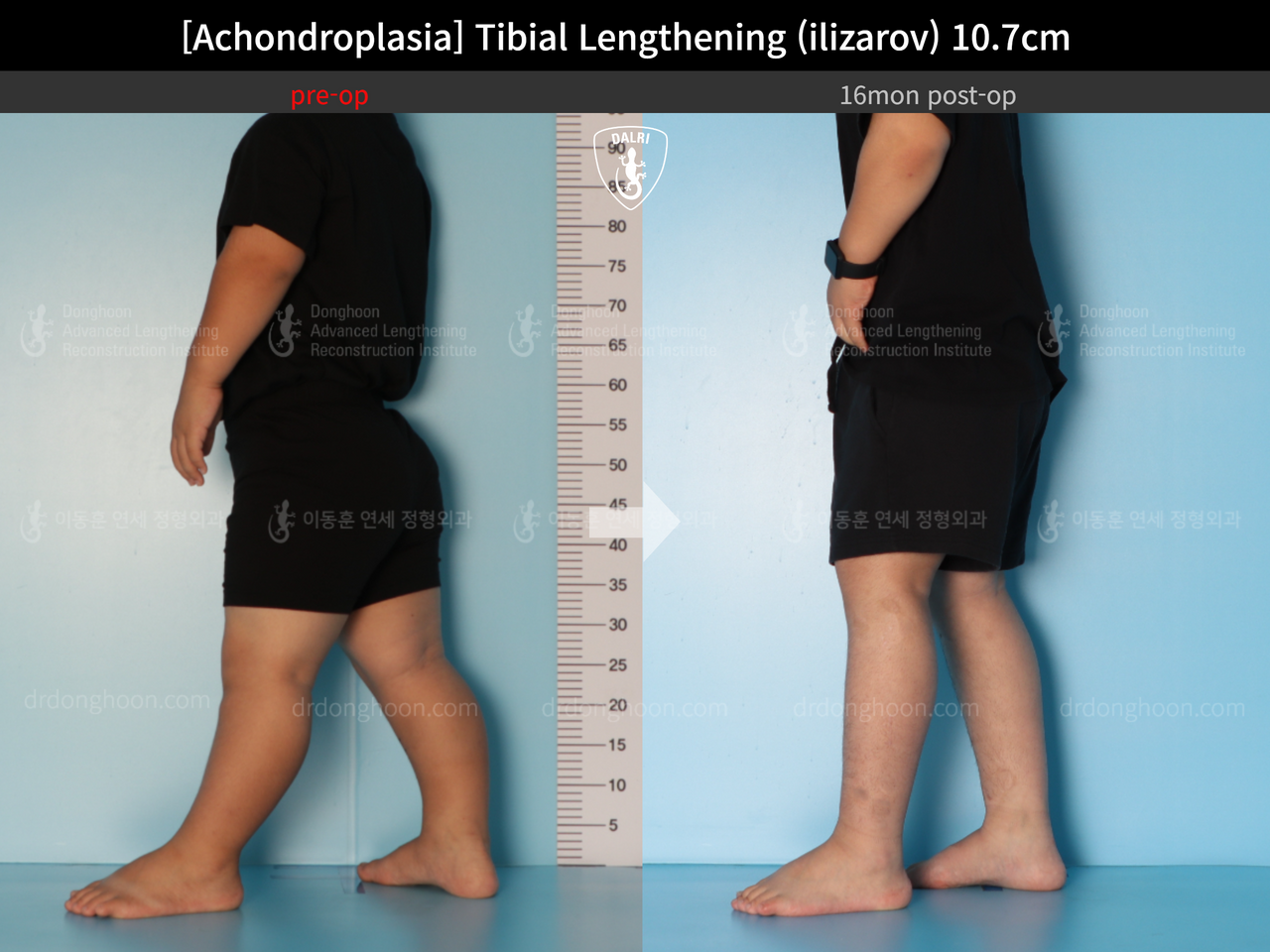 Before and after paediatric congenital condition, case 13489647, image 7, Dr. Donghoon institute (DALRI)