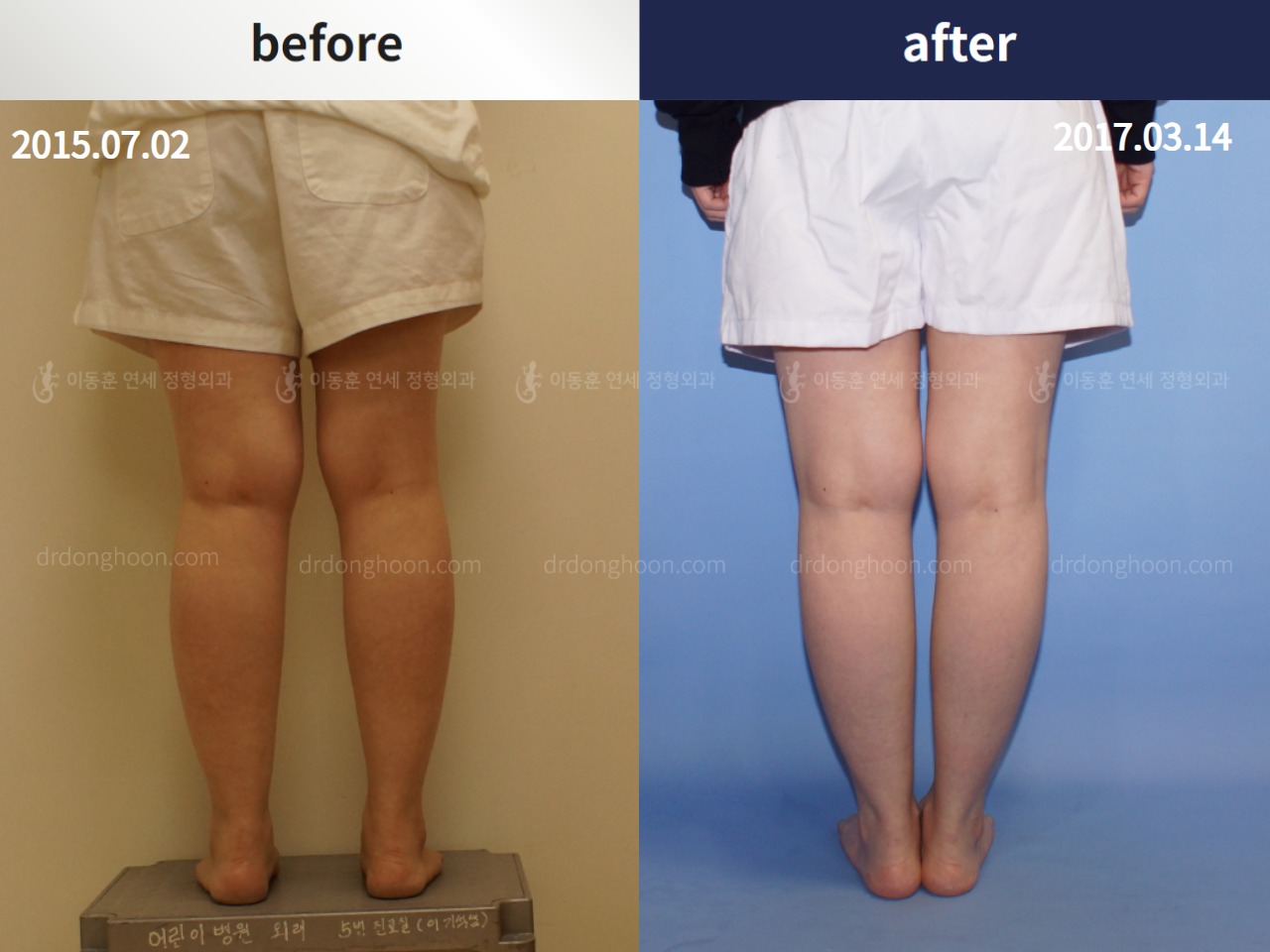 Before and after adult knock knees, case 4310831, image 3, Dr. Donghoon institute (DALRI)