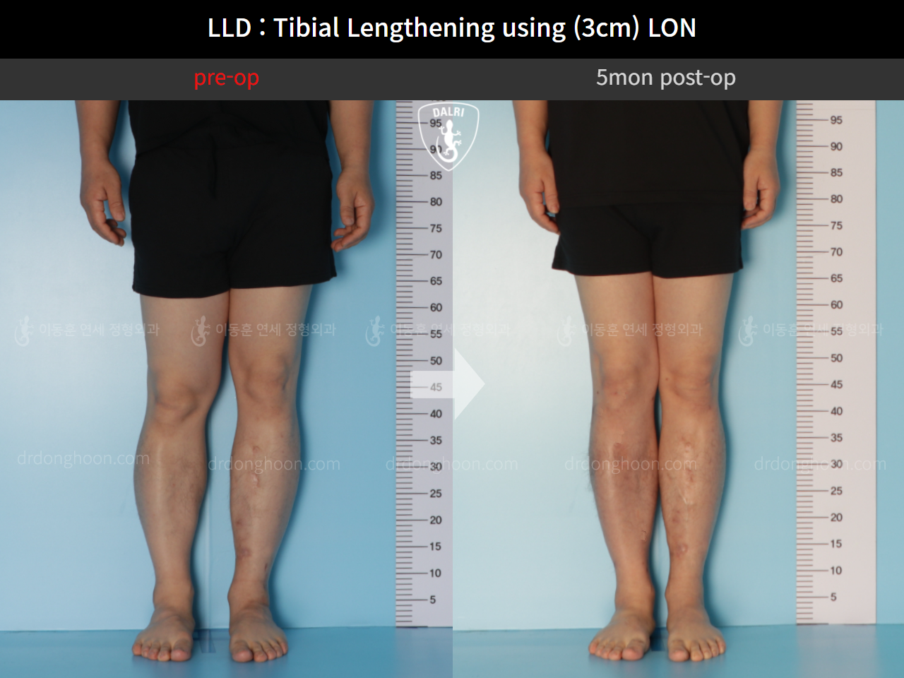 Before and after adult lld, case 11139768, image 4, Dr. Donghoon institute (DALRI)
