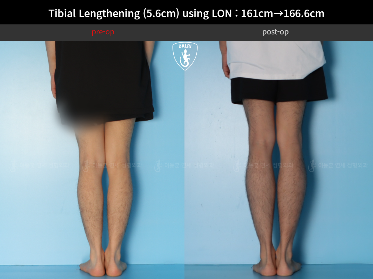 Before and after cll lon, case 126542150, image 6, Dr. Donghoon institute (DALRI)