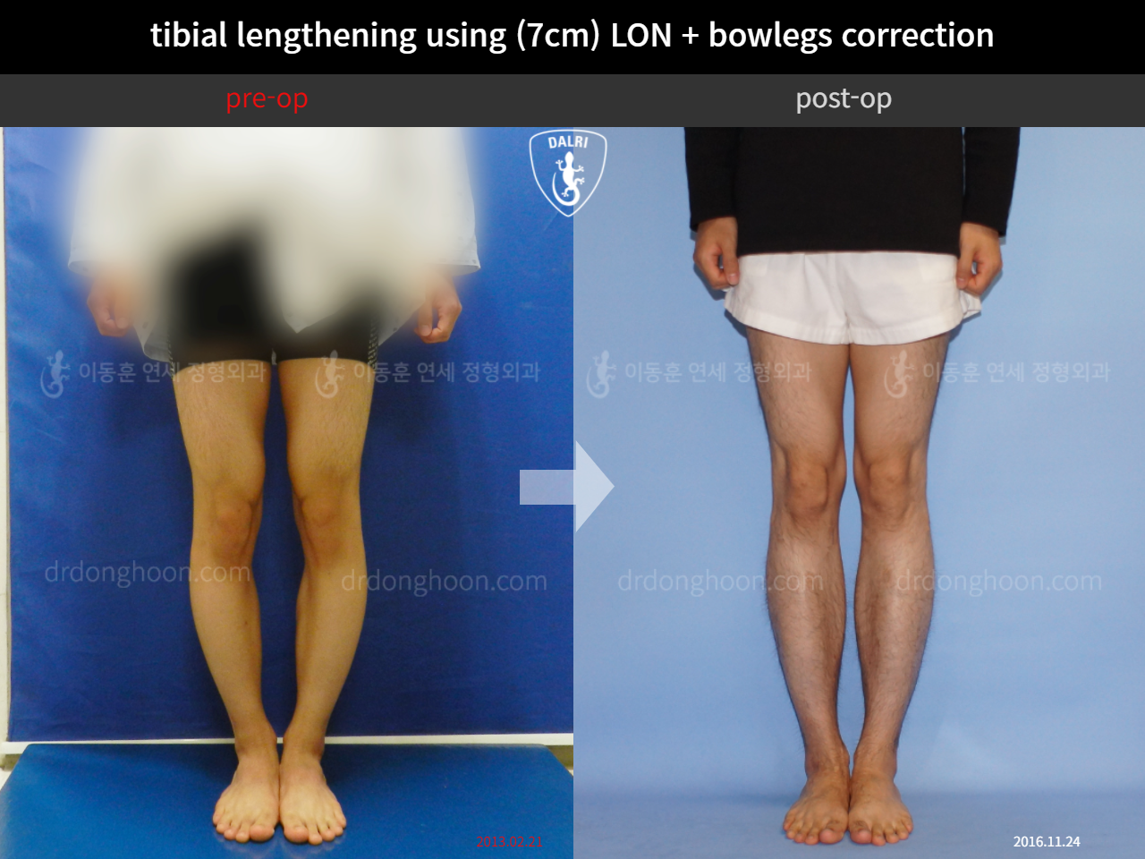 Before and after cll + deformity correction, case 4323143, image 3, Dr. Donghoon institute (DALRI)