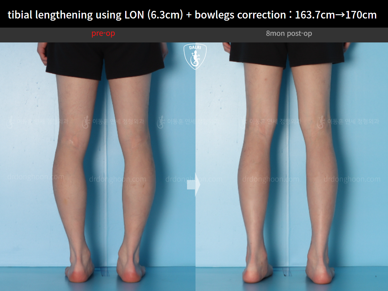 Before and after cll + deformity correction, case 16853829, image 10, Dr. Donghoon institute (DALRI)