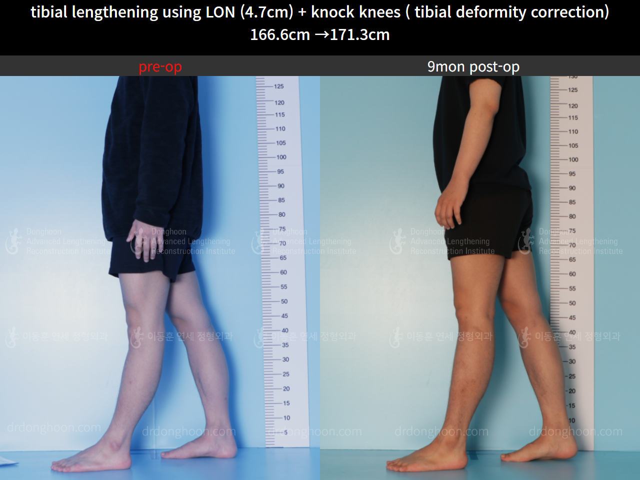 Before and after cll + deformity correction, case 8583829, image 3, Dr. Donghoon institute (DALRI)