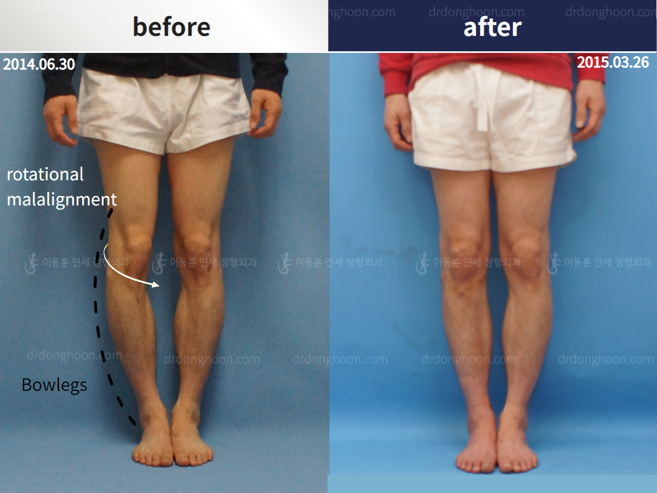 Before and after complex deformity, case 4251637, image 2, Dr. Donghoon institute (DALRI)