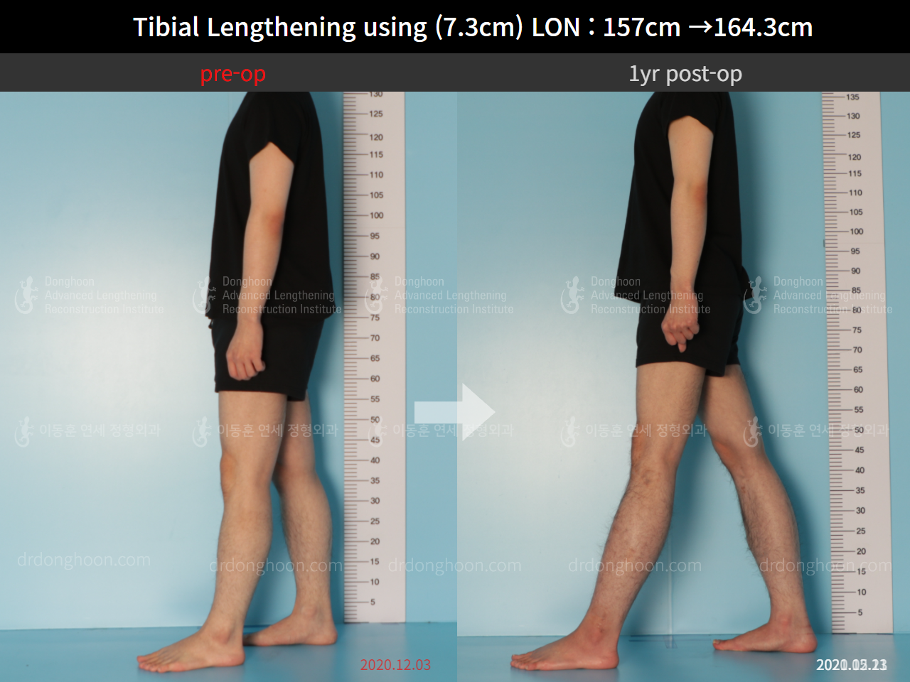 Before and after cll lon, case 9114235, image 4, Dr. Donghoon institute (DALRI)