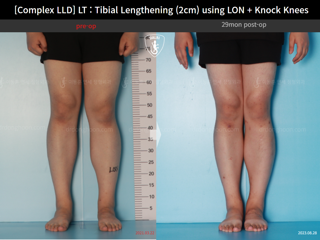 Before and after adult lld, case 16165477, image 5, Dr. Donghoon institute (DALRI)