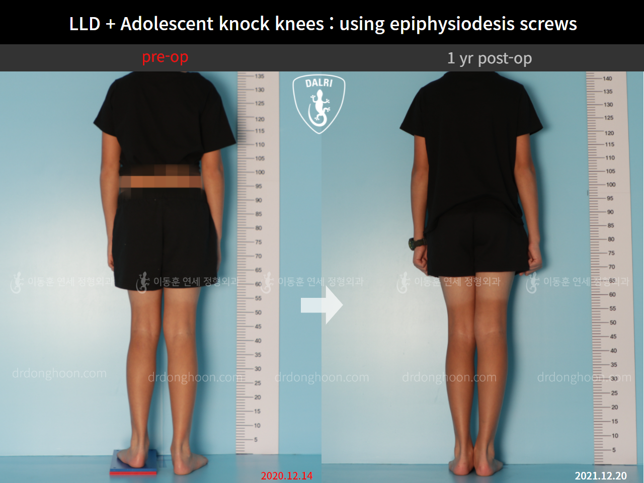 Before and after paediatric & adolescent knock knees, case 9186061, image 6, Dr. Donghoon institute (DALRI)