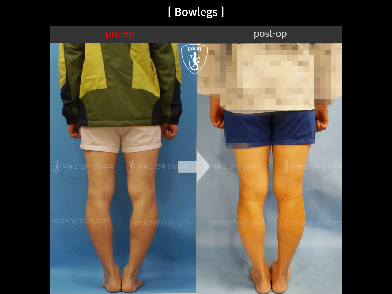 Before and after adult bowlegs, case 4311160, image 3, Dr. Donghoon institute (DALRI)