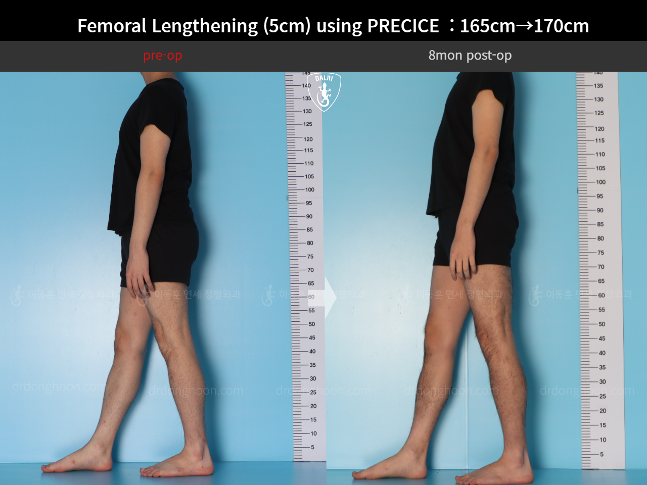 Before and after cll precice, case 18356944, image 4, Dr. Donghoon institute (DALRI)