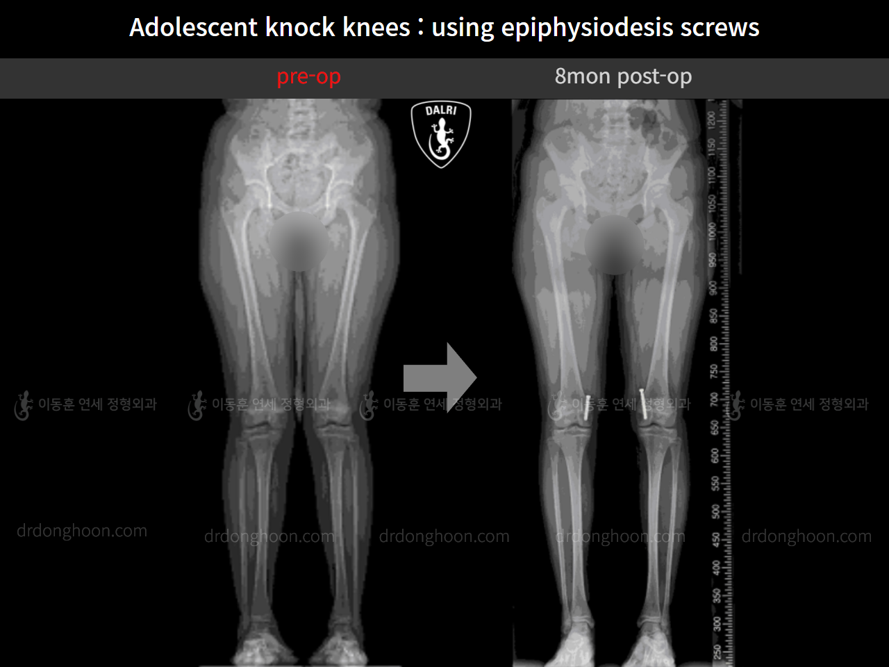 Before and after paediatric & adolescent knock knees, case 10297056, image 6, Dr. Donghoon institute (DALRI)