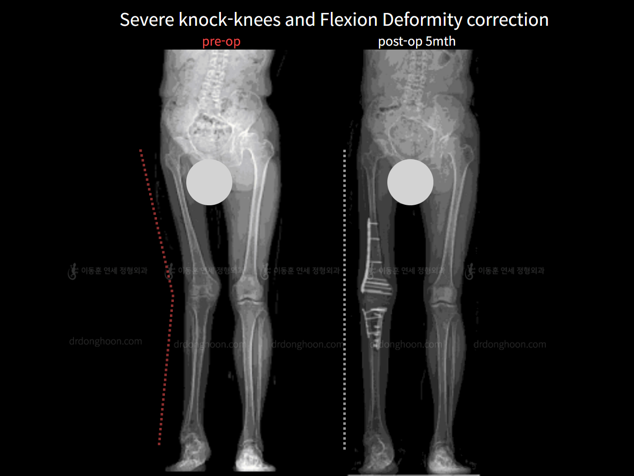 Before and after congenital condition, case 6779119, image 2, Dr. Donghoon institute (DALRI)