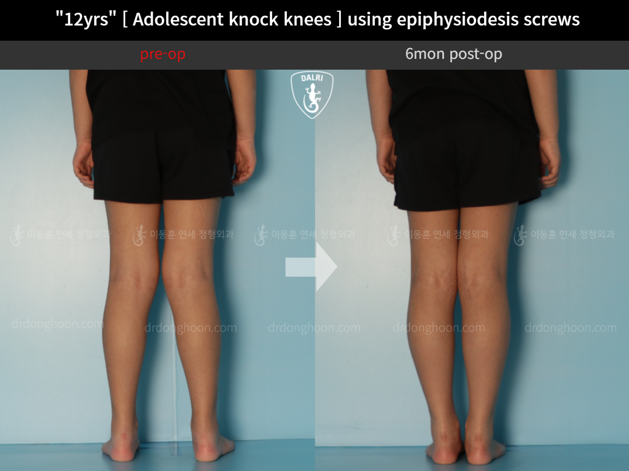 Before and after paediatric & adolescent knock knees, case 11772990, image 4, Dr. Donghoon institute (DALRI)