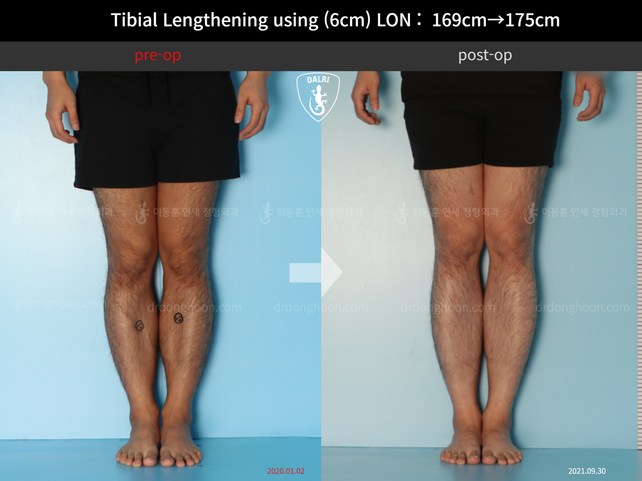Before and after cll lon, case 12279515, image 5, Dr. Donghoon institute (DALRI)