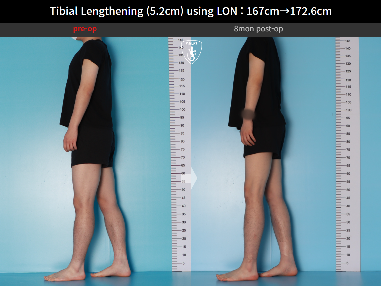 Before and after cll lon, case 29672720, image 3, Dr. Donghoon institute (DALRI)