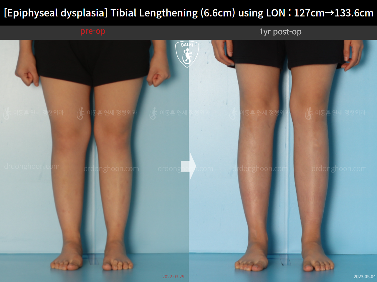 Before and after congenital condition, case 15072062, image 8, Dr. Donghoon institute (DALRI)