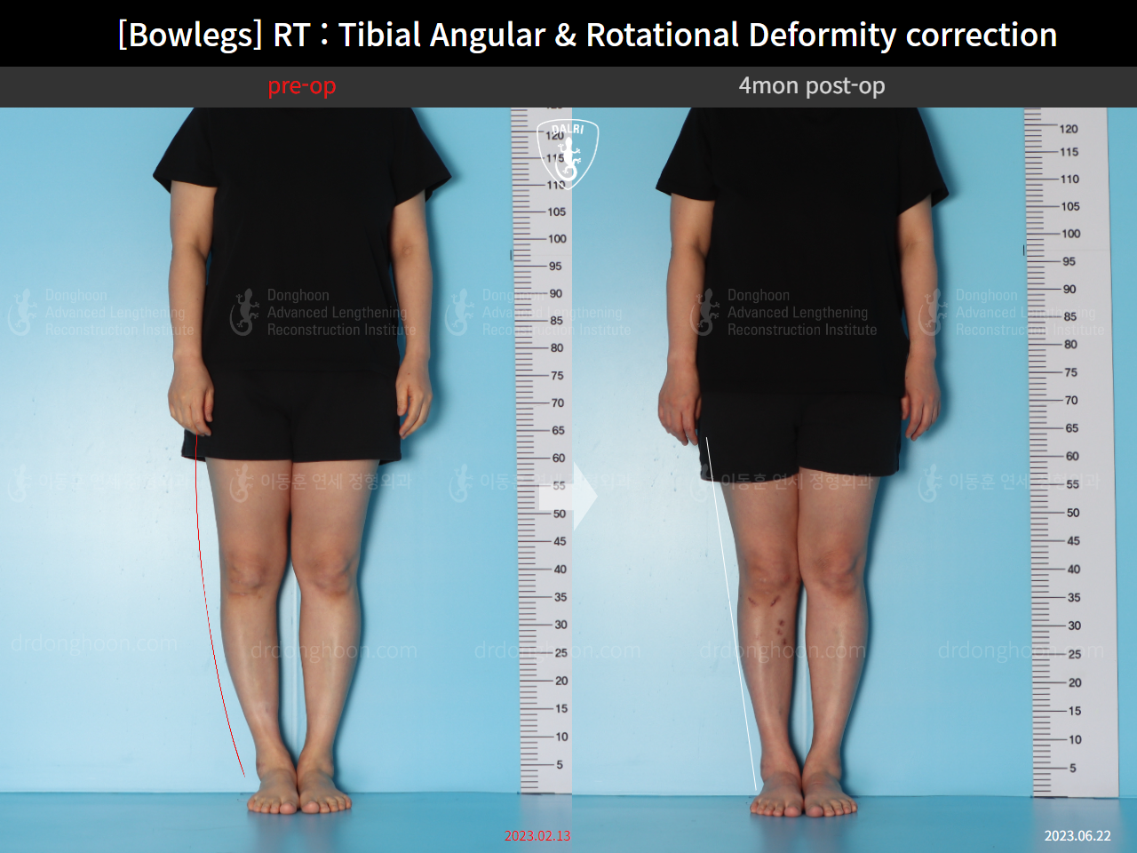 Before and after adult bowlegs, case 15741874, image 1, Dr. Donghoon institute (DALRI)
