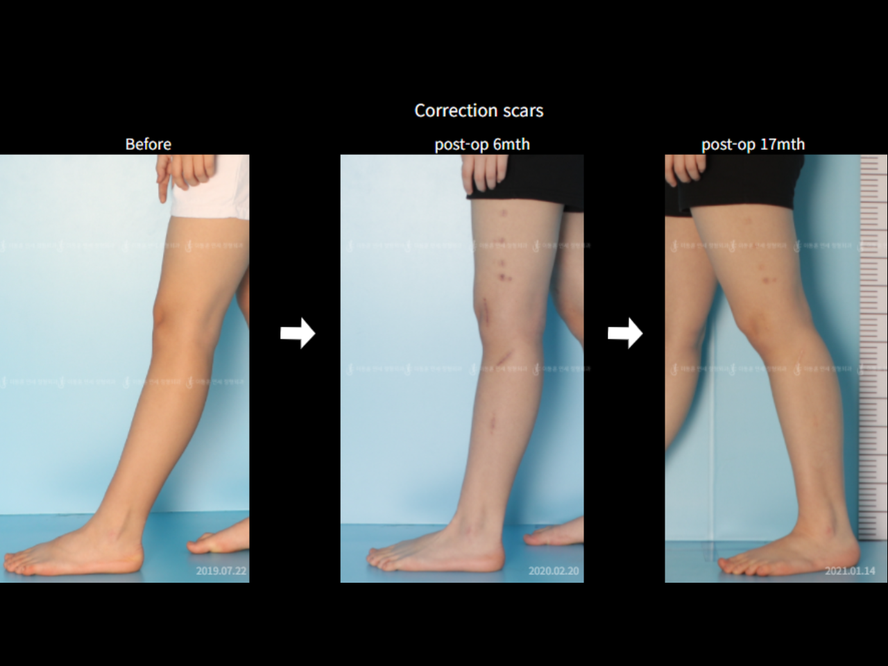 Before and after adult bowlegs, case 6883070, image 7, Dr. Donghoon institute (DALRI)