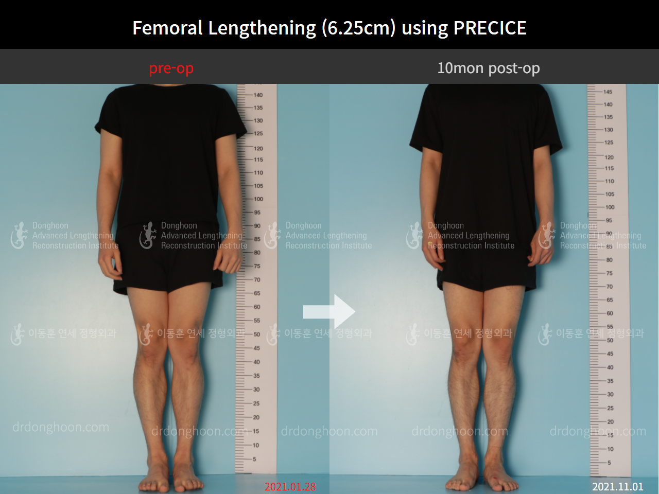Before and after cll precice, case 8759307, image 1, Dr. Donghoon institute (DALRI)