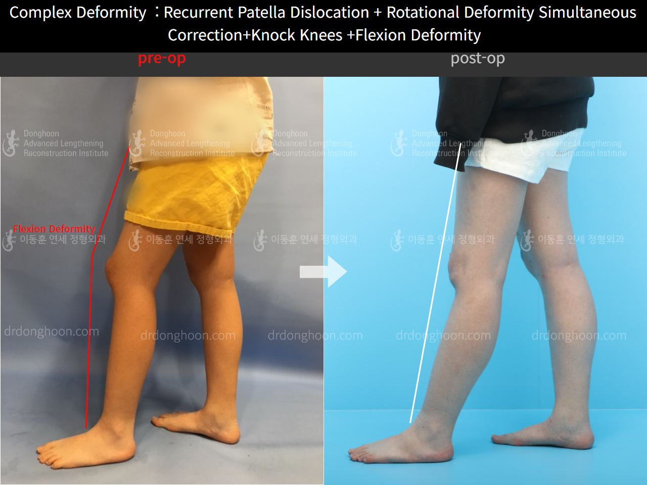 Before and after recurrent patella dislocation, case 4263760, image 3, Dr. Donghoon institute (DALRI)
