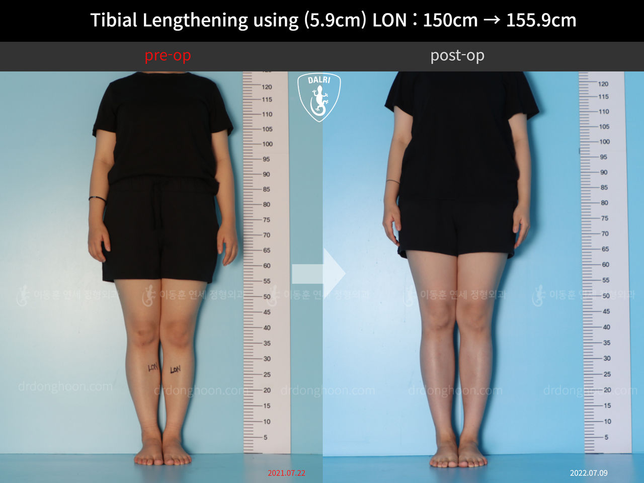 Before and after cll lon, case 12207071, image 1, Dr. Donghoon institute (DALRI)