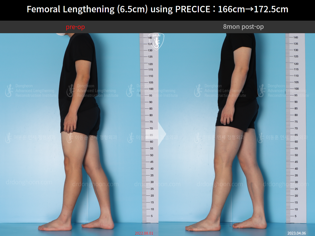 Before and after cll precice, case 14706614, image 5, Dr. Donghoon institute (DALRI)
