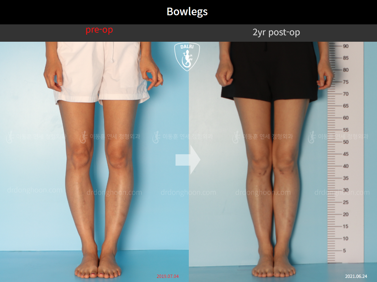Before and after adult bowlegs, case 10023318, image 7, Dr. Donghoon institute (DALRI)