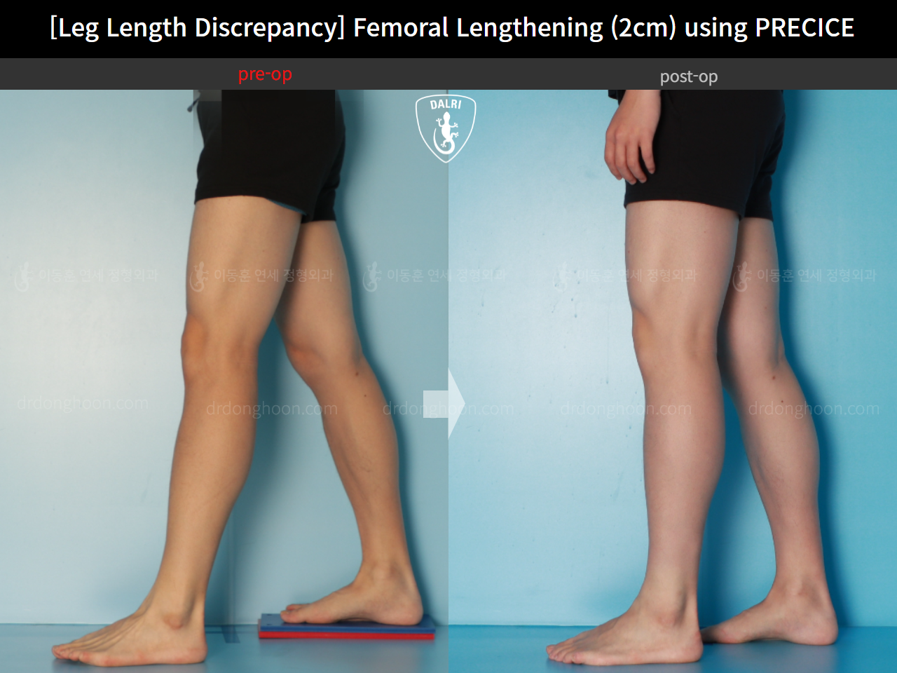 Before and after adult lld, case 16061128, image 9, Dr. Donghoon institute (DALRI)
