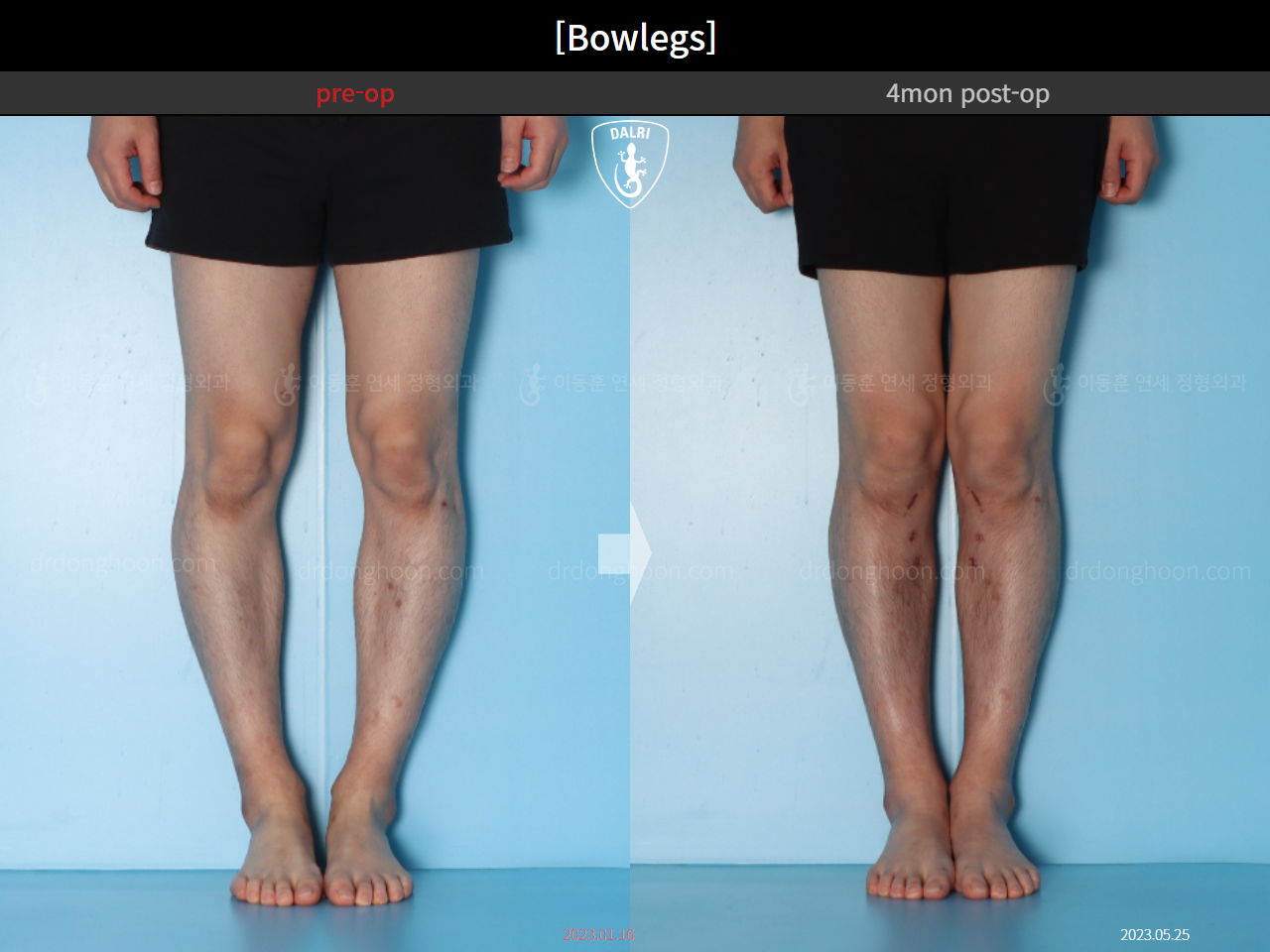 Before and after adult bowlegs, case 15650289, image 6, Dr. Donghoon institute (DALRI)