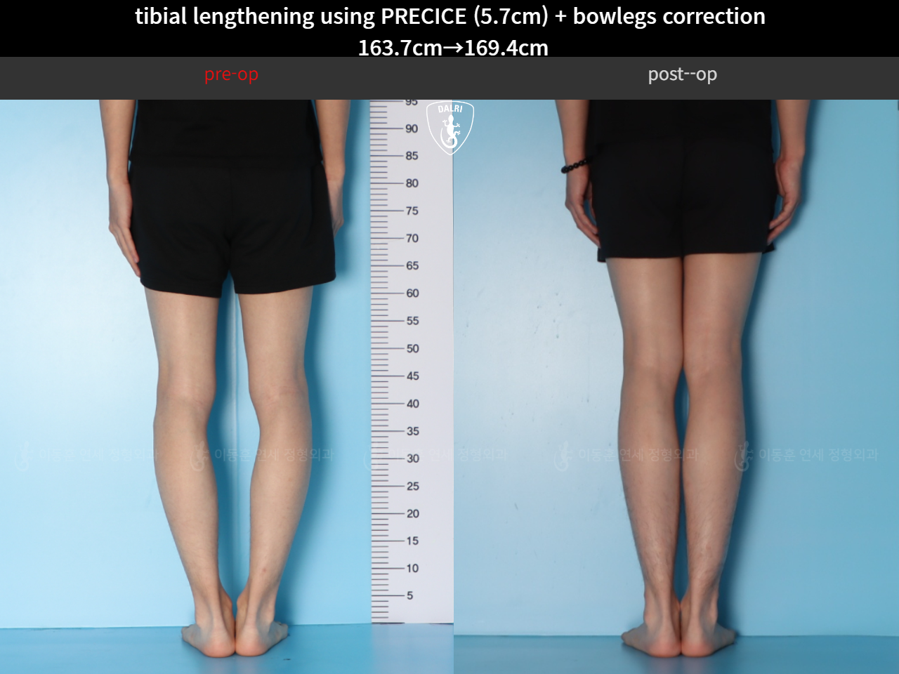 Before and after cll precice, case 38471448, image 6, Dr. Donghoon institute (DALRI)