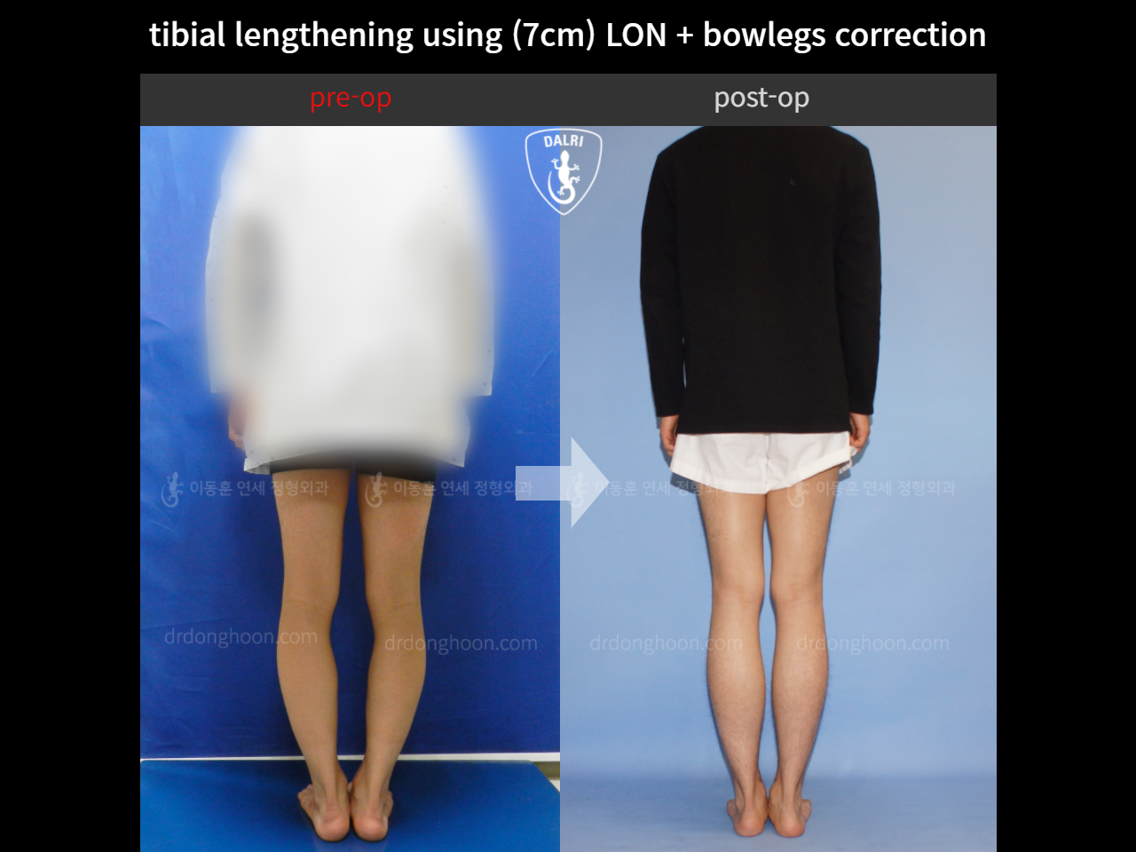 Before and after cll + deformity correction, case 4323143, image 2, Dr. Donghoon institute (DALRI)
