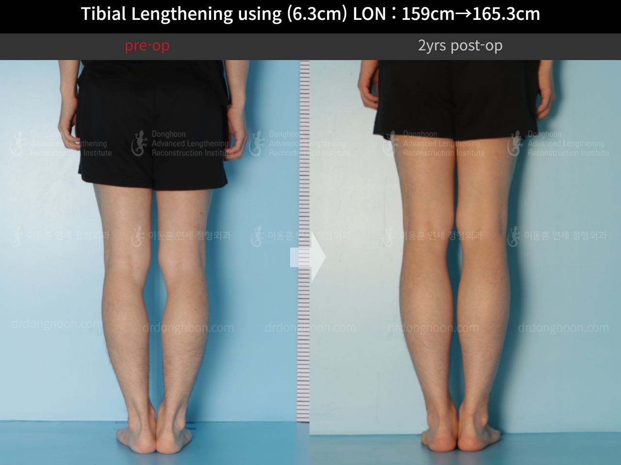 Before and after cll lon, case 12096536, image 8, Dr. Donghoon institute (DALRI)