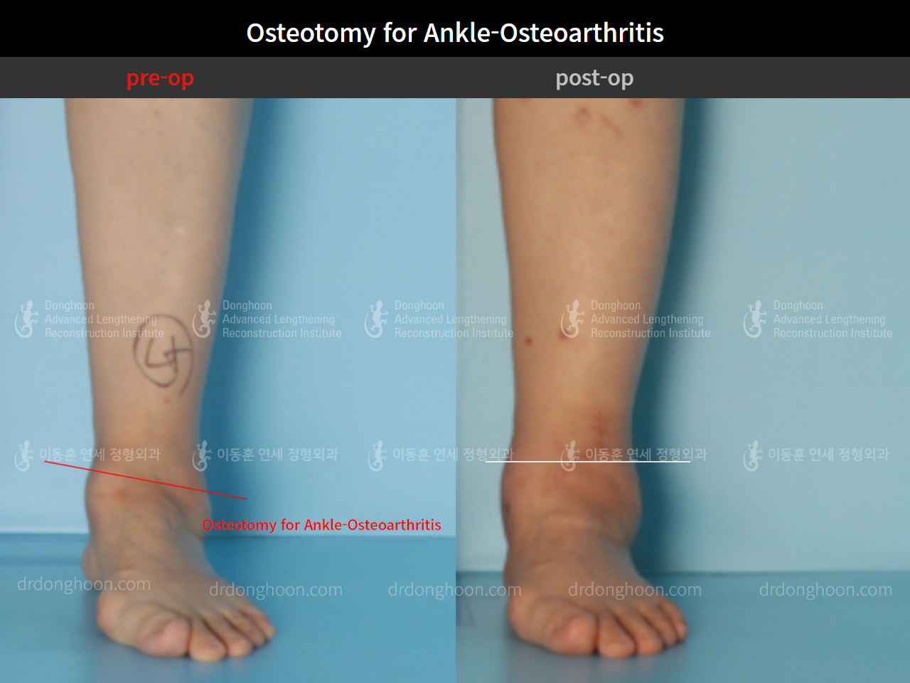 Before and after foot & ankle deformity, case 9057682, image 2, Dr. Donghoon institute (DALRI)