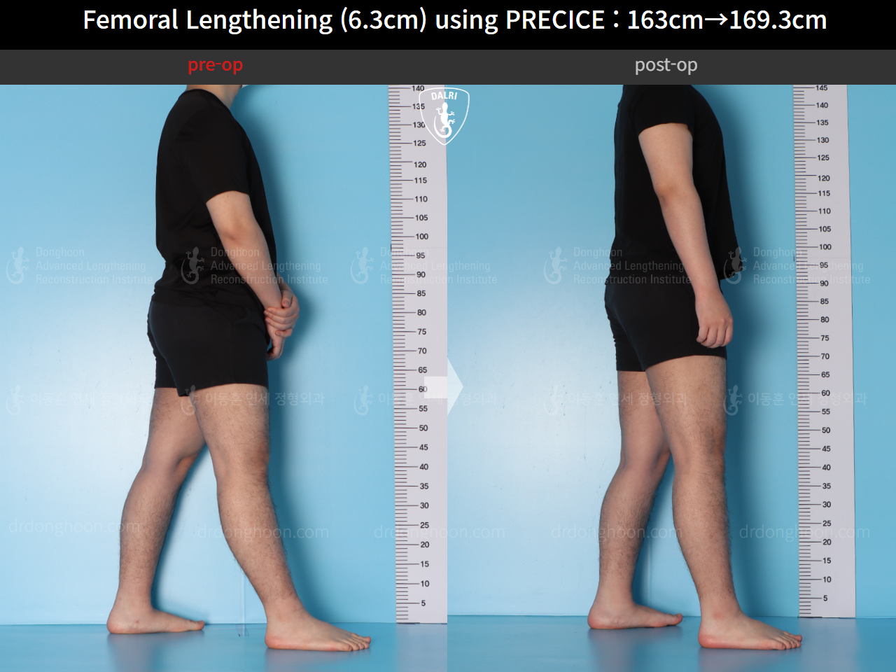 Before and after cll precice, case 15639837, image 8, Dr. Donghoon institute (DALRI)