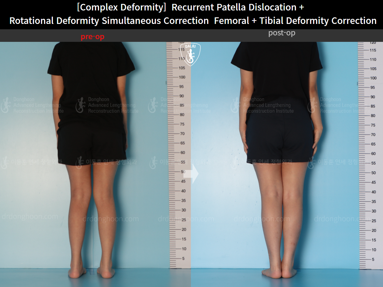 Before and after complex deformity, case 16298867, image 3, Dr. Donghoon institute (DALRI)