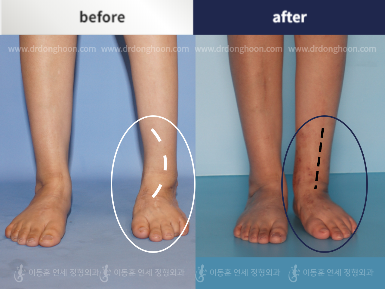 Before and after congenital condition, case 4795353, image 4, Dr. Donghoon institute (DALRI)