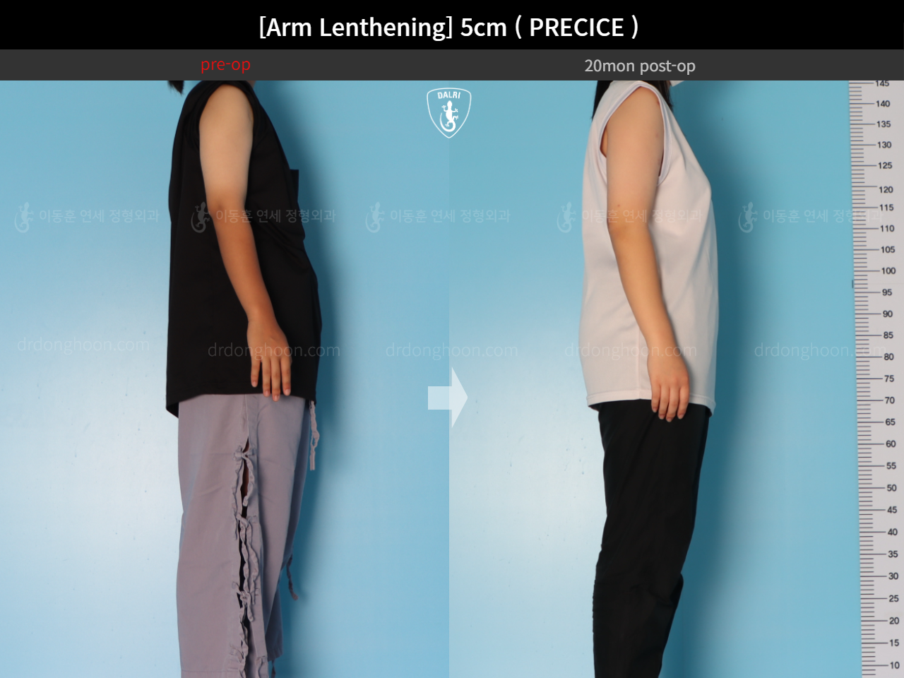 Before and after arm lengthening, case 18471704, image 3, Dr. Donghoon institute (DALRI)