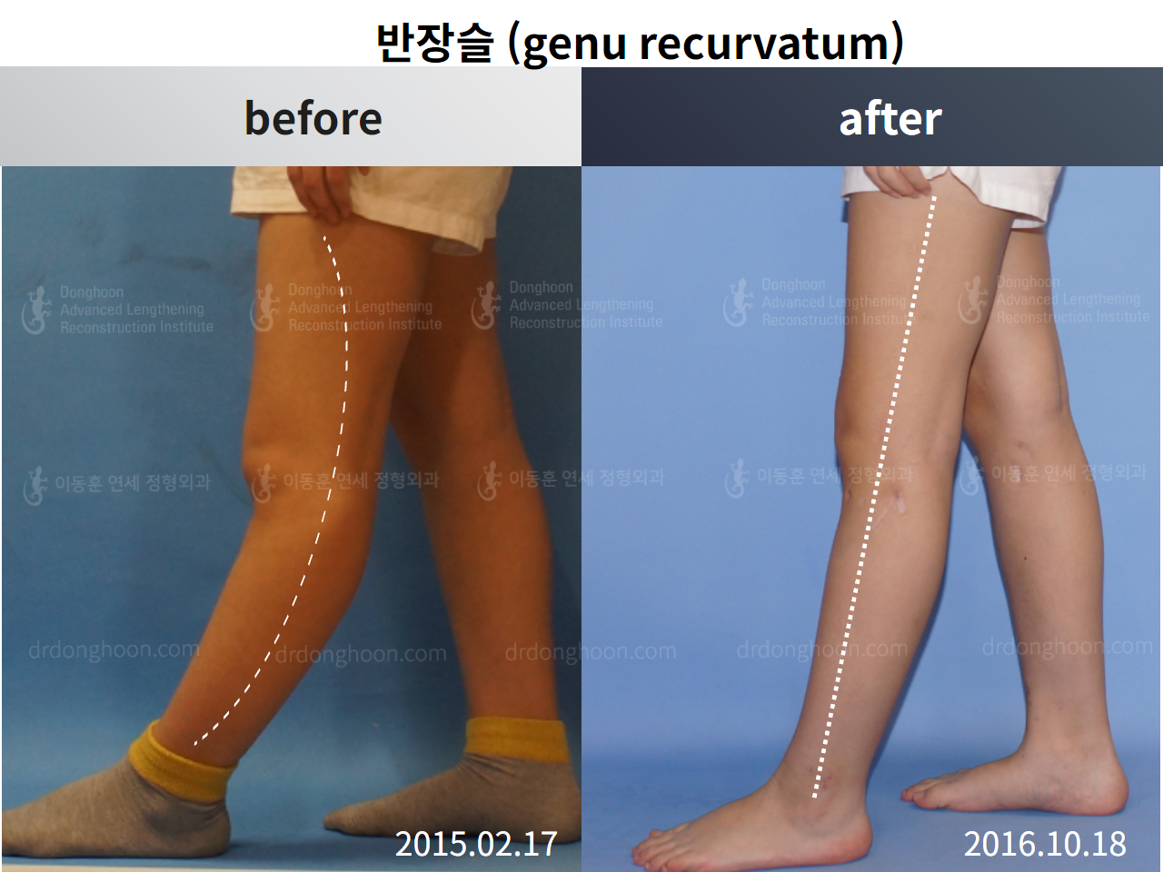 Before and after paediatric & adolescent bowlegs, case 4320276, image 4, Dr. Donghoon institute (DALRI)