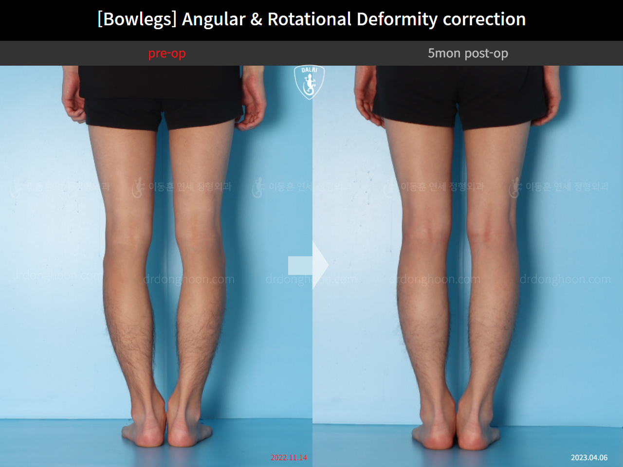 Before and after adult bowlegs, case 14707617, image 8, Dr. Donghoon institute (DALRI)