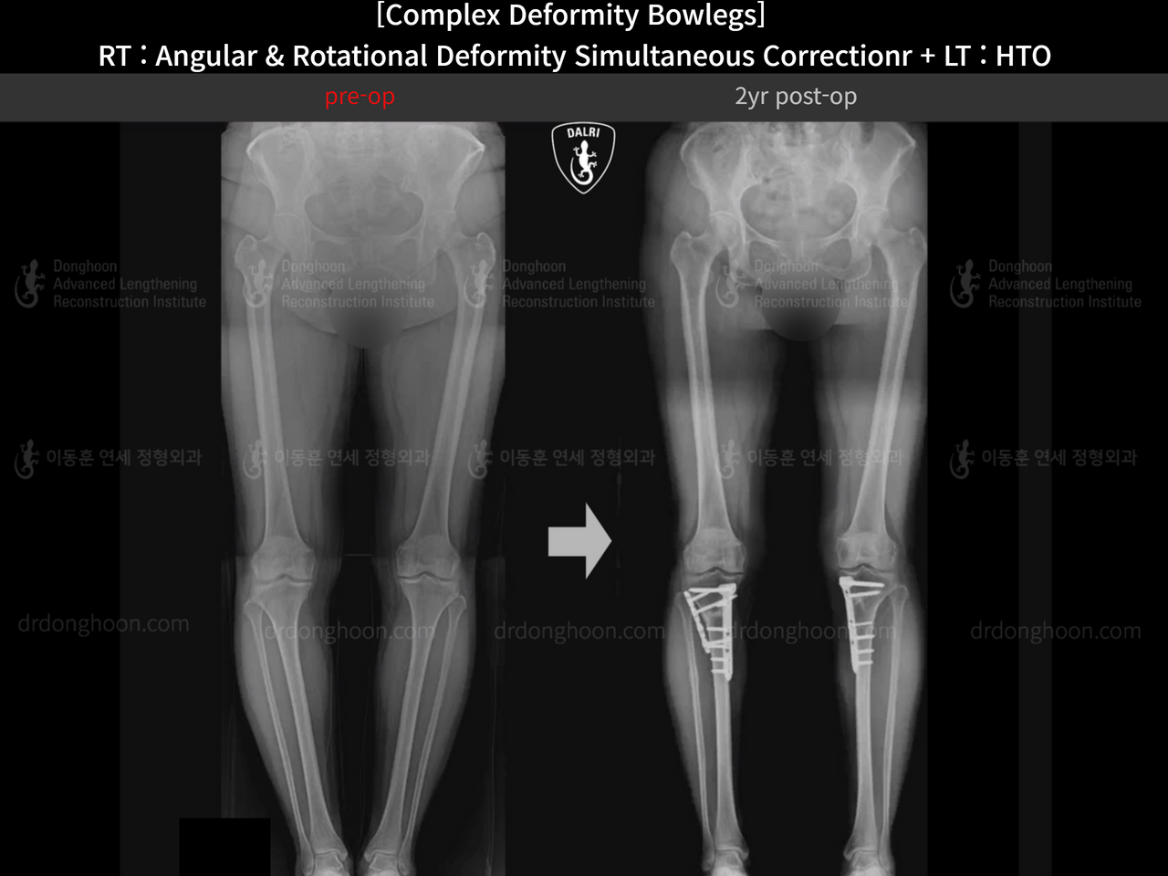 Before and after adult bowlegs, case 14328178, image 6, Dr. Donghoon institute (DALRI)