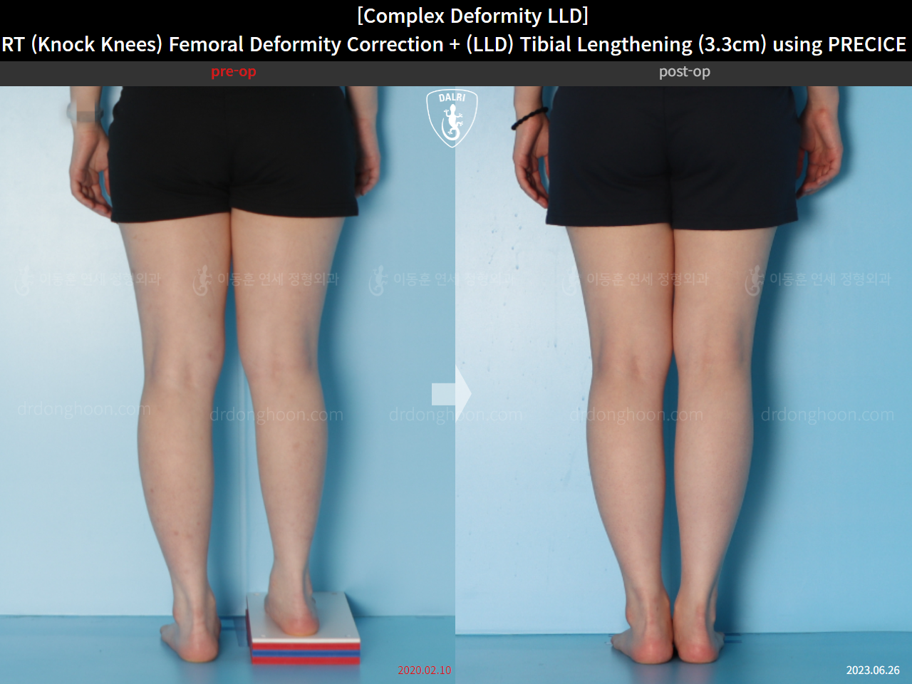 Before and after adult lld, case 15584036, image 6, Dr. Donghoon institute (DALRI)