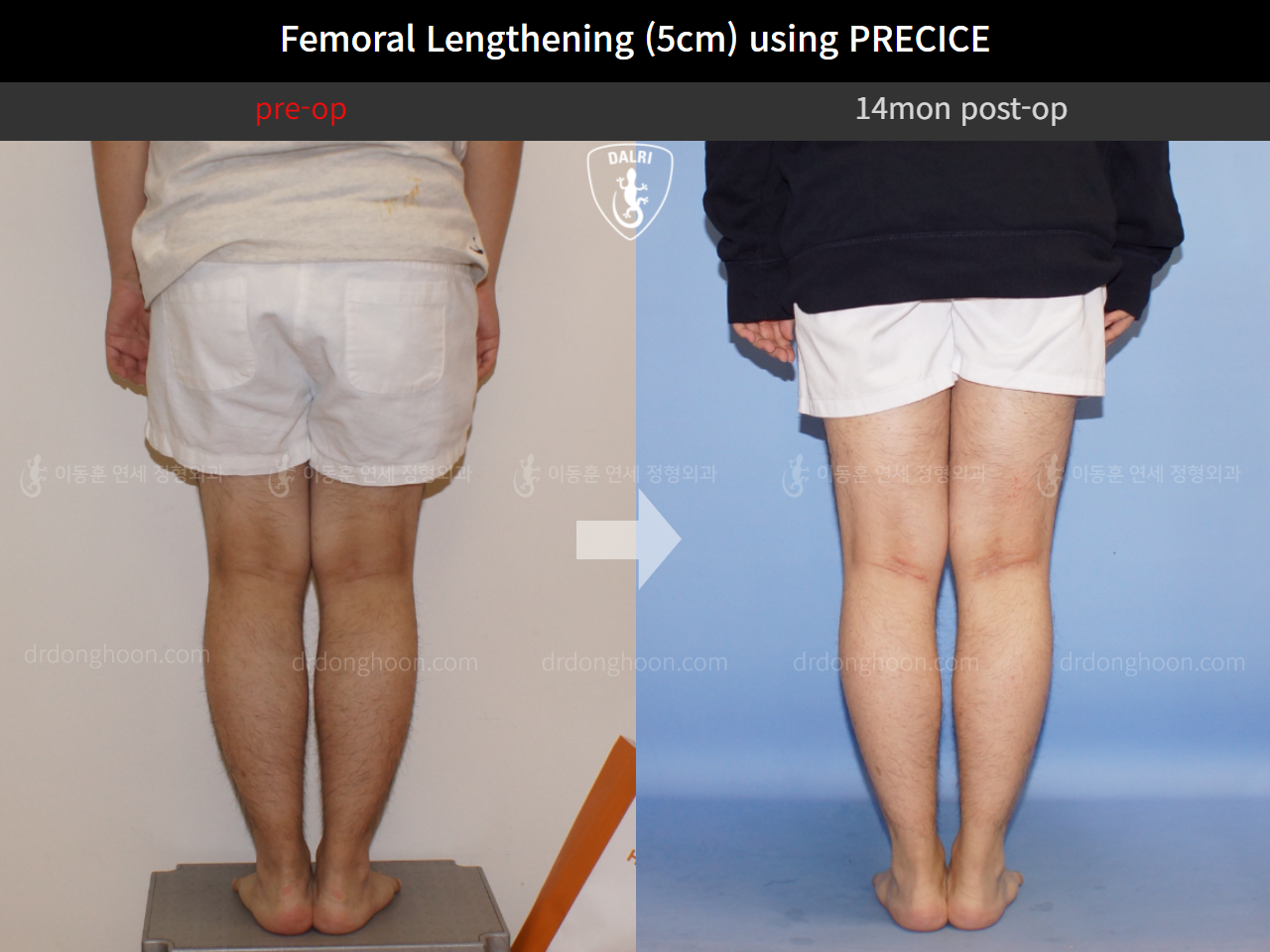Before and after cll precice, case 4323249, image 6, Dr. Donghoon institute (DALRI)