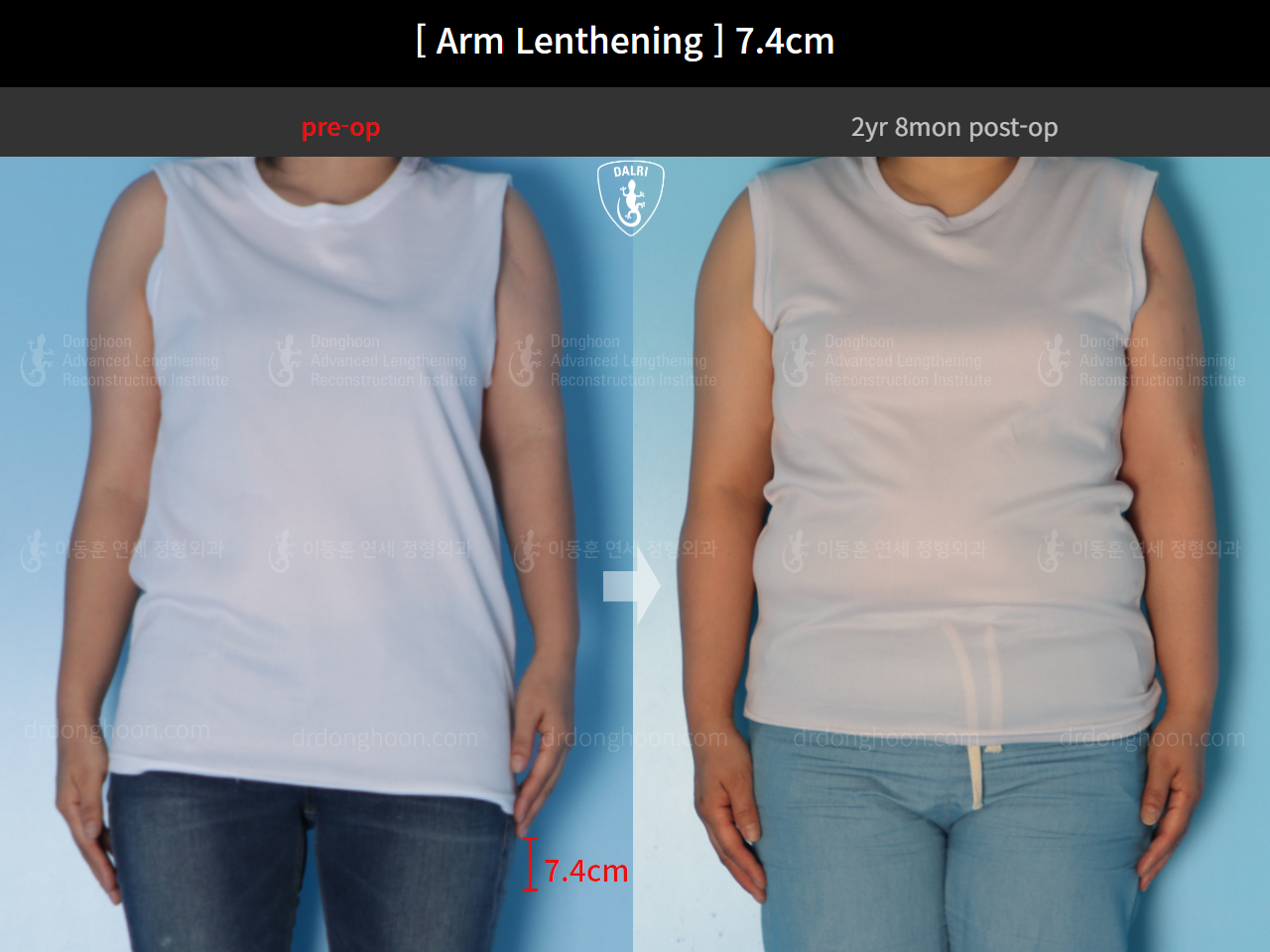 Before and after arm lengthening, case 15460631, image 1, Dr. Donghoon institute (DALRI)