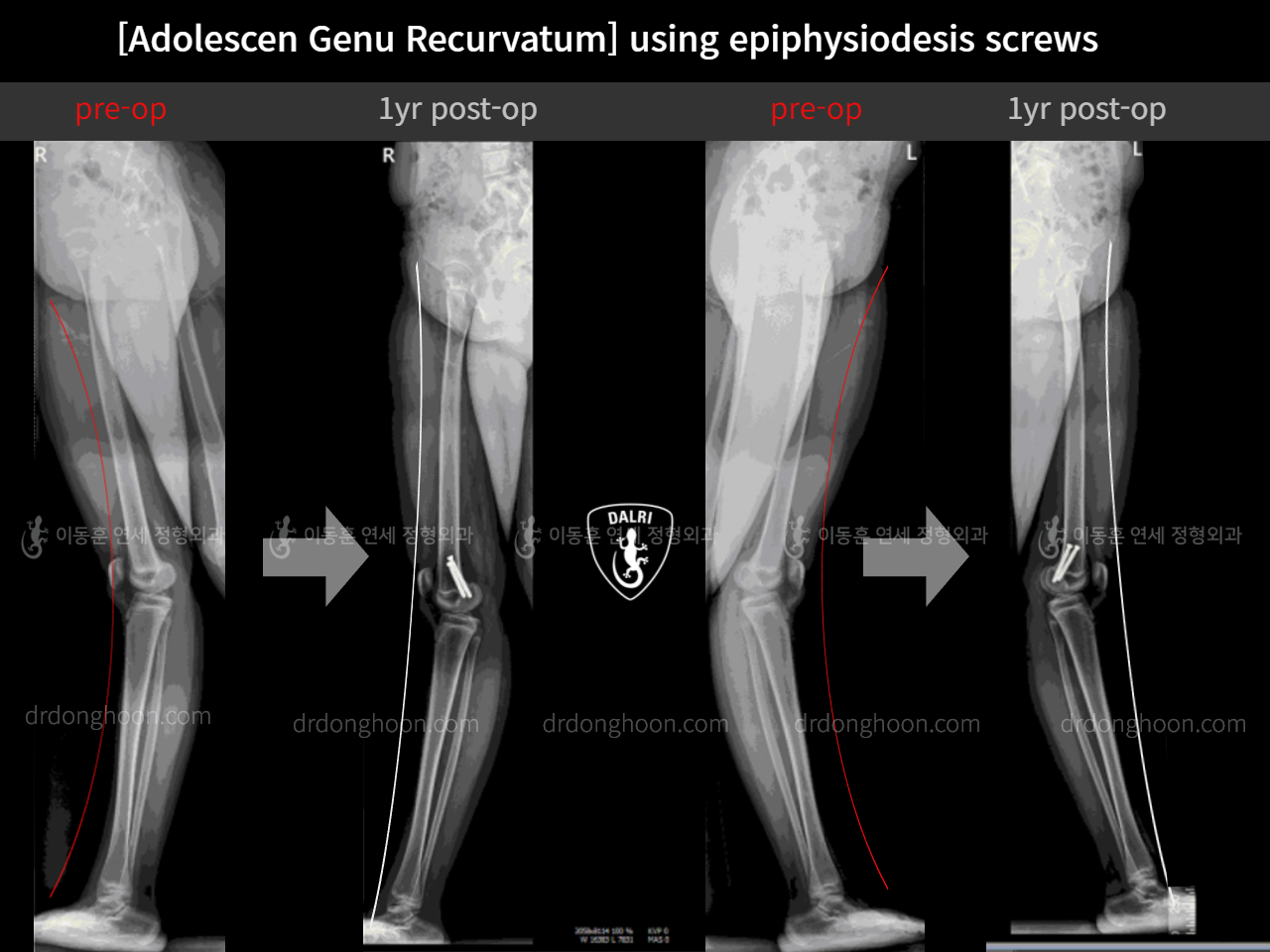 Before and after paediatric & adolescent knock knees, case 11515487, image 1, Dr. Donghoon institute (DALRI)