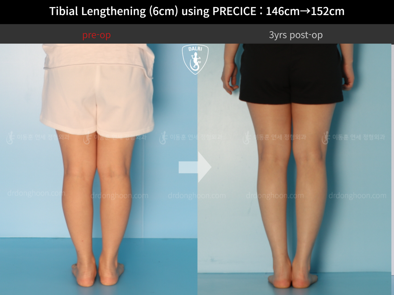 Before and after cll precice, case 4573599, image 6, Dr. Donghoon institute (DALRI)