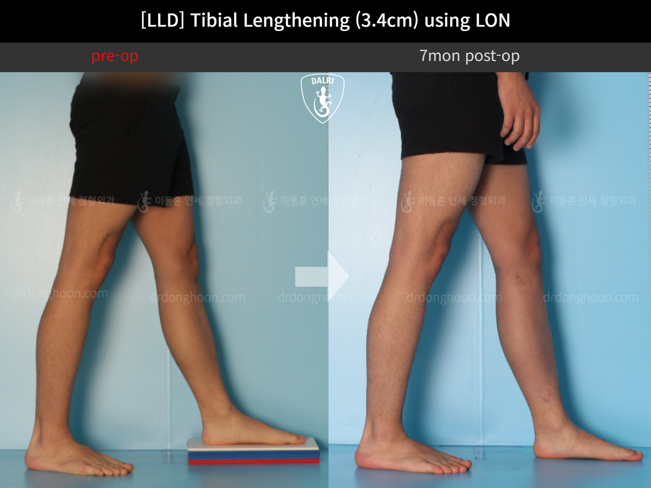 Before and after adult lld, case 12529689, image 6, Dr. Donghoon institute (DALRI)