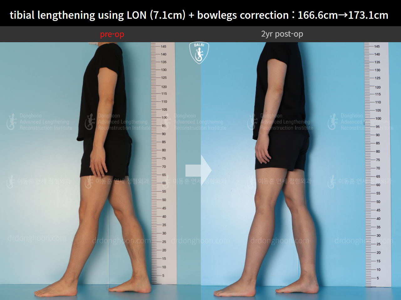 Before and after cll lon, case 14678740, image 5, Dr. Donghoon institute (DALRI)