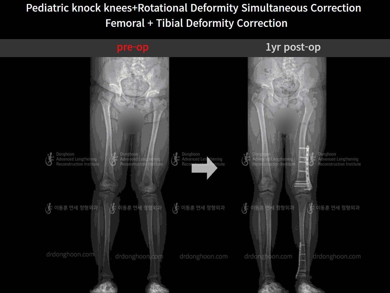 Before and after paediatric & adolescent knock knees, case 4640495, image 5, Dr. Donghoon institute (DALRI)