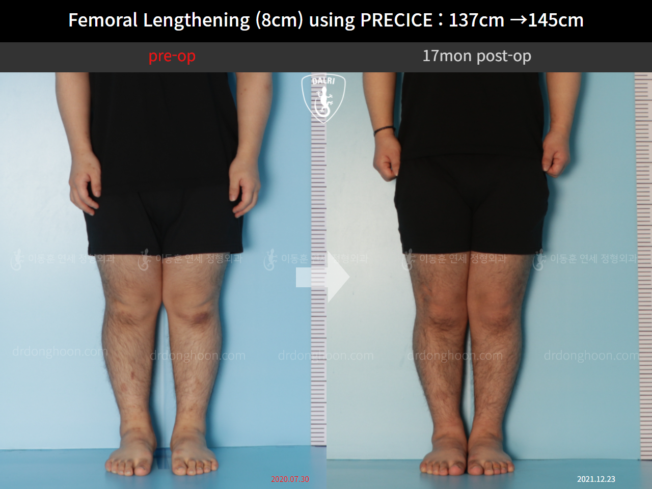 Before and after cll precice, case 9658893, image 5, Dr. Donghoon institute (DALRI)