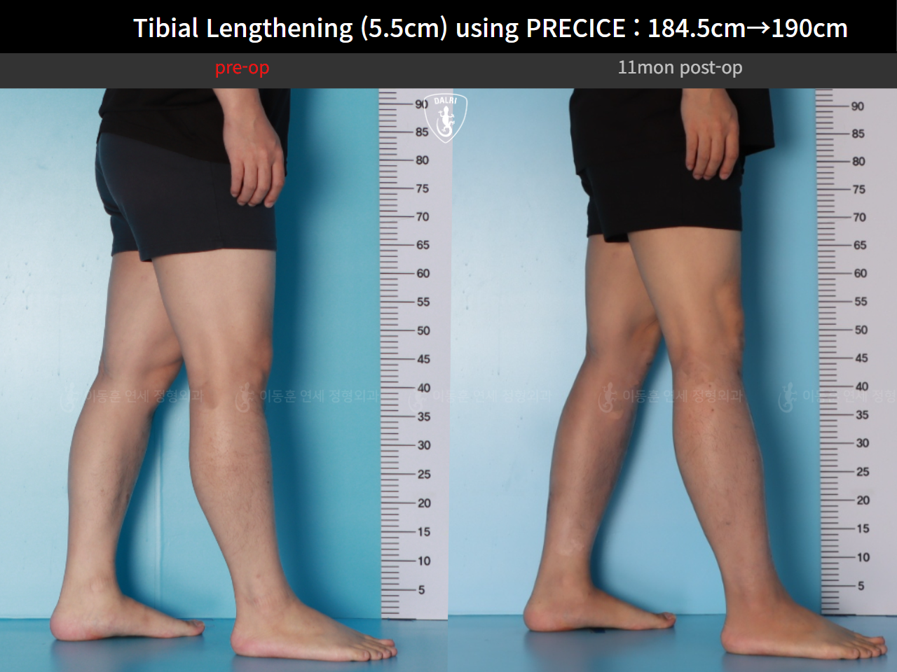 Before and after cll precice, case 125279355, image 9, Dr. Donghoon institute (DALRI)