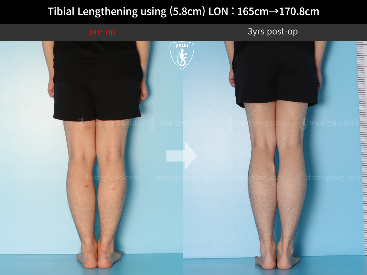 Before and after cll lon, case 12828098, image 5, Dr. Donghoon institute (DALRI)